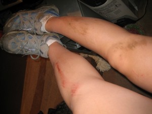 leg scrape from mountain biking